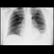 Pulmonary infarction, pulmonary embolism: X-ray - Plain radiograph